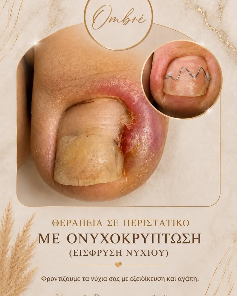 Ονυχοκρύπτωση