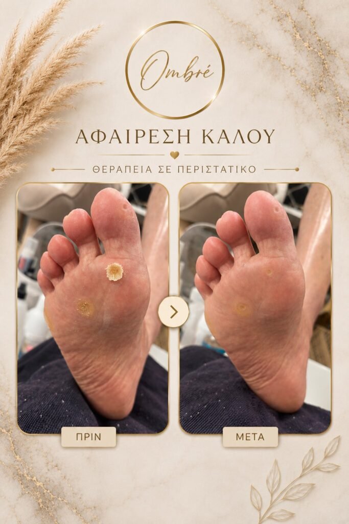 Πριν και μετά από αφαίρεση κάλου στο πέλμα
