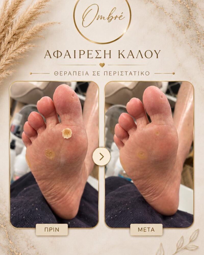 Αφαίρεση κάλου
